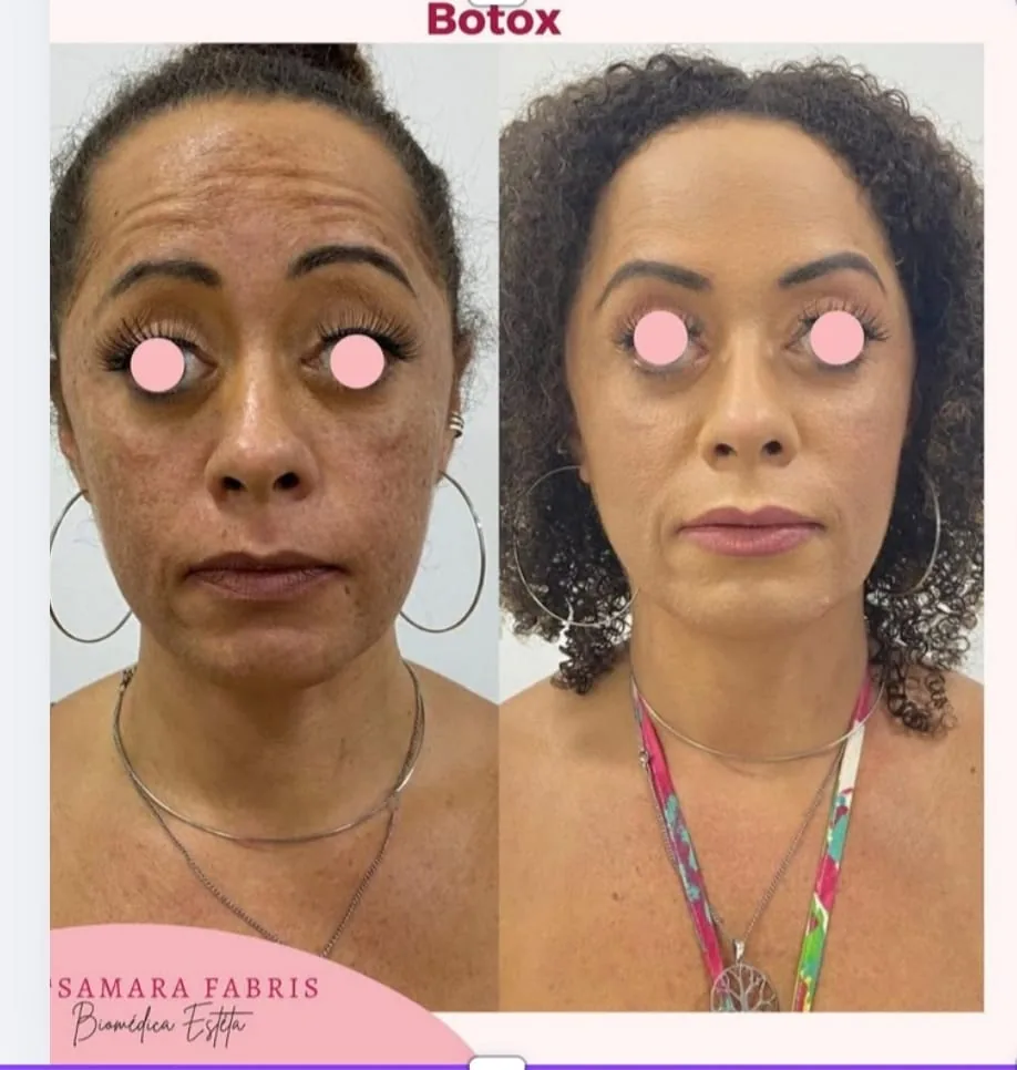 Toxina botulínica