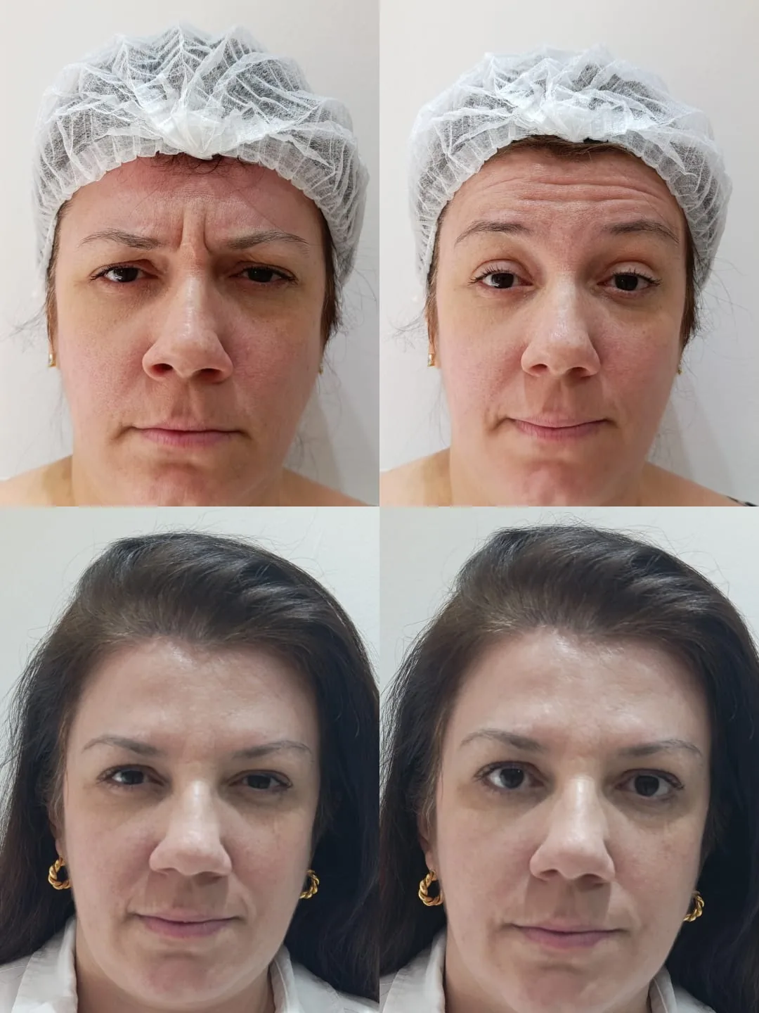 Antes e depois de toxina botulínica na glabela