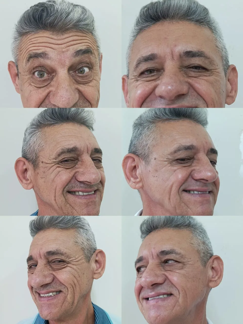 Toxina botulínica masculina