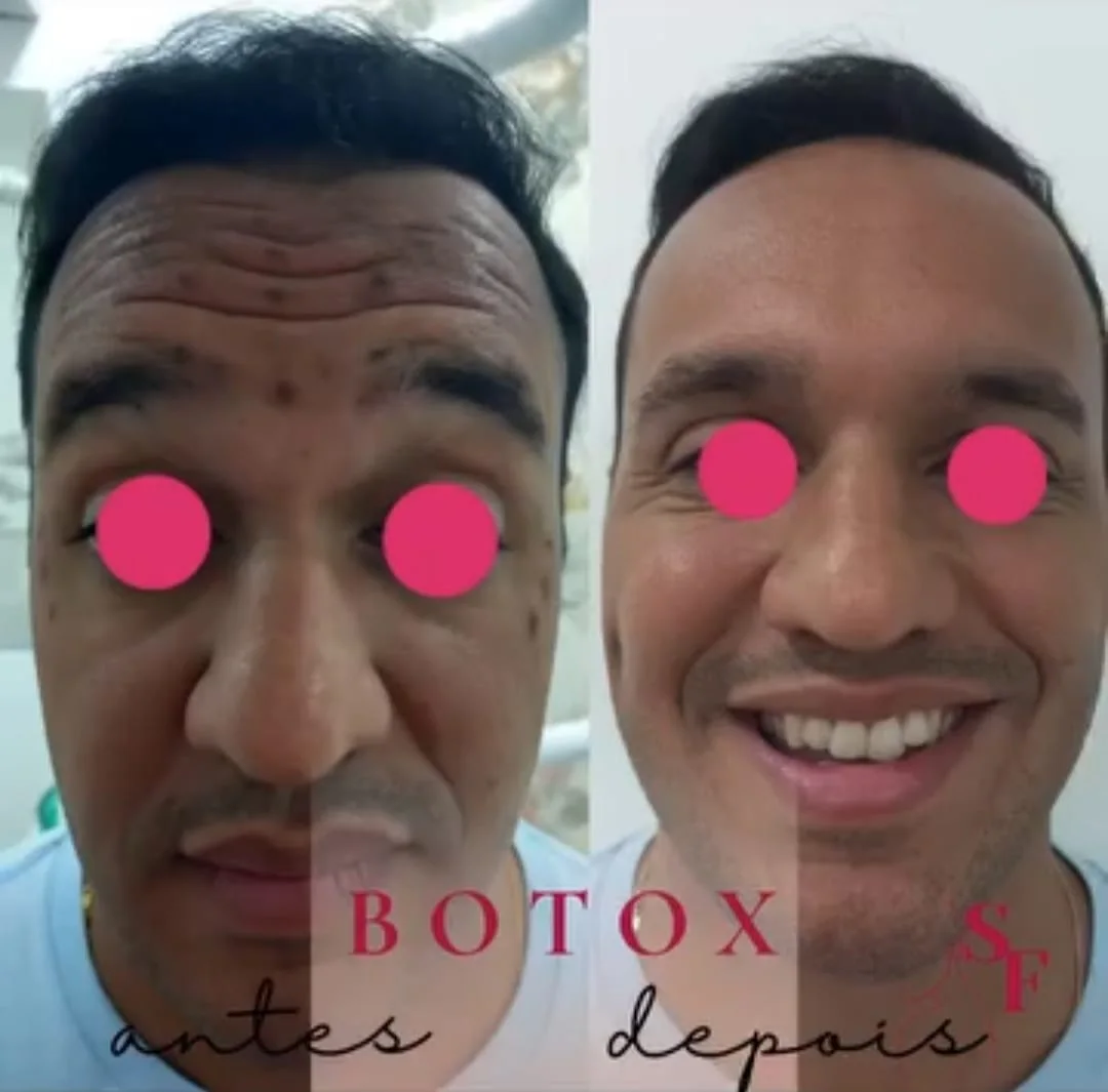Antes e depois de toxina botulínica em paciente homem