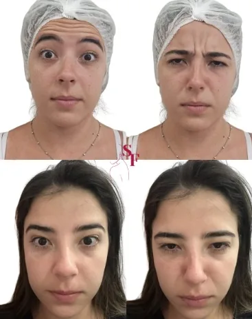 Pele hidratada após skinbooster