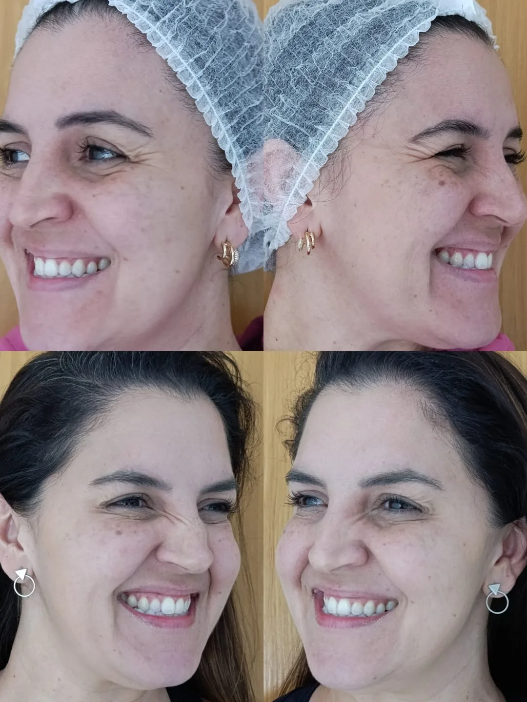 Toxina botulínica, pés de galinha