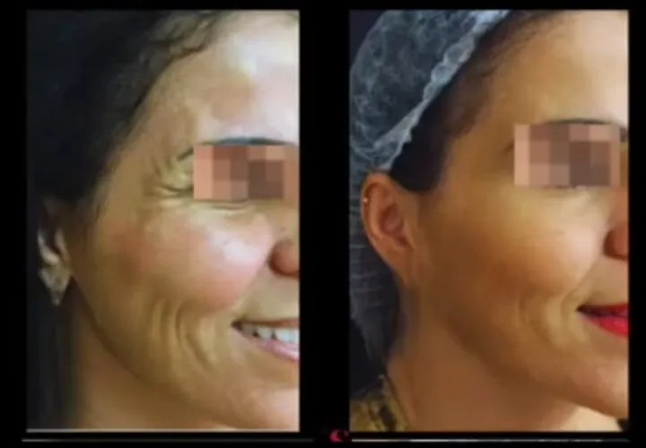 Antes e depois de toxina botulínica associada a ultrassom microfocado