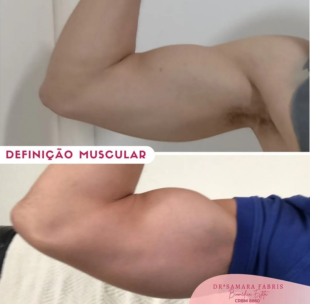 Antes e depois de definição muscular no braço