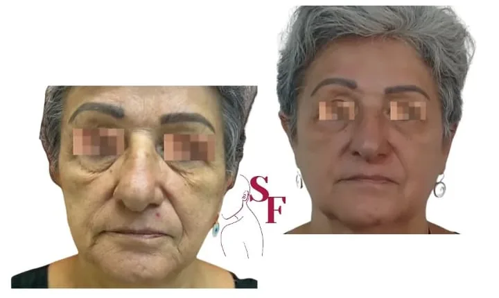 Antes e depois de Endolaser facial