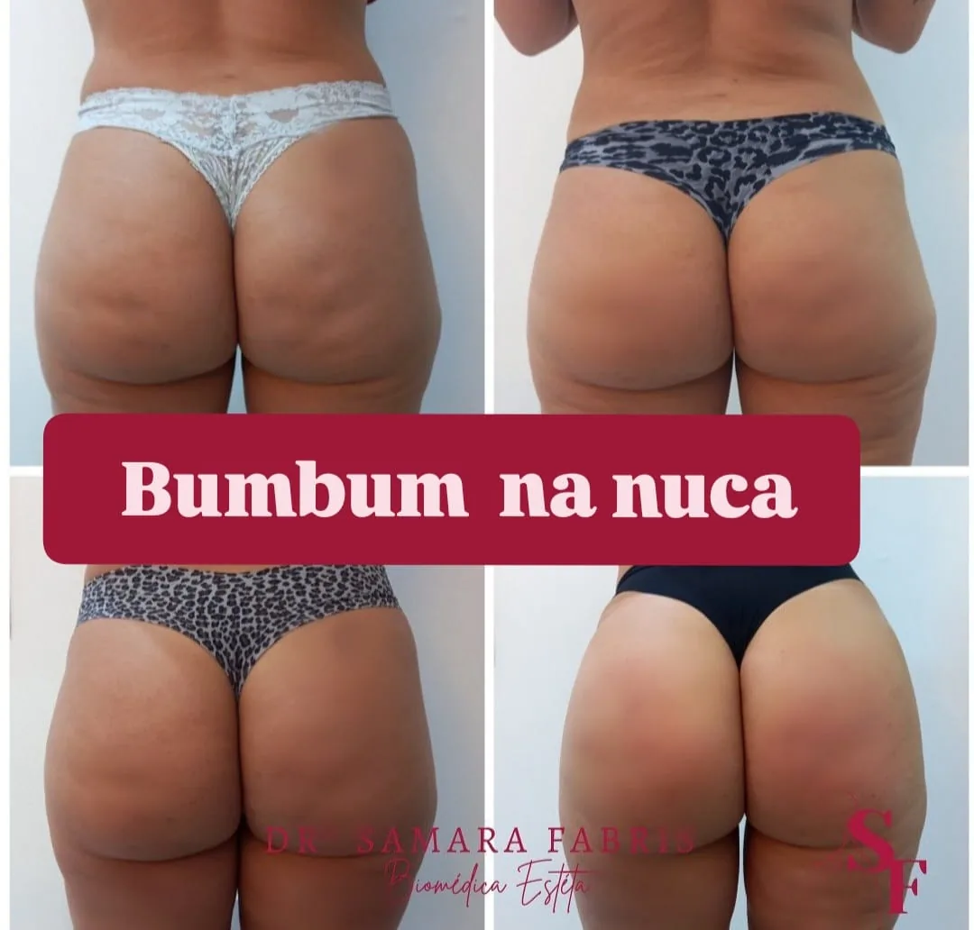 Antes e depois de harmonização de glúteos