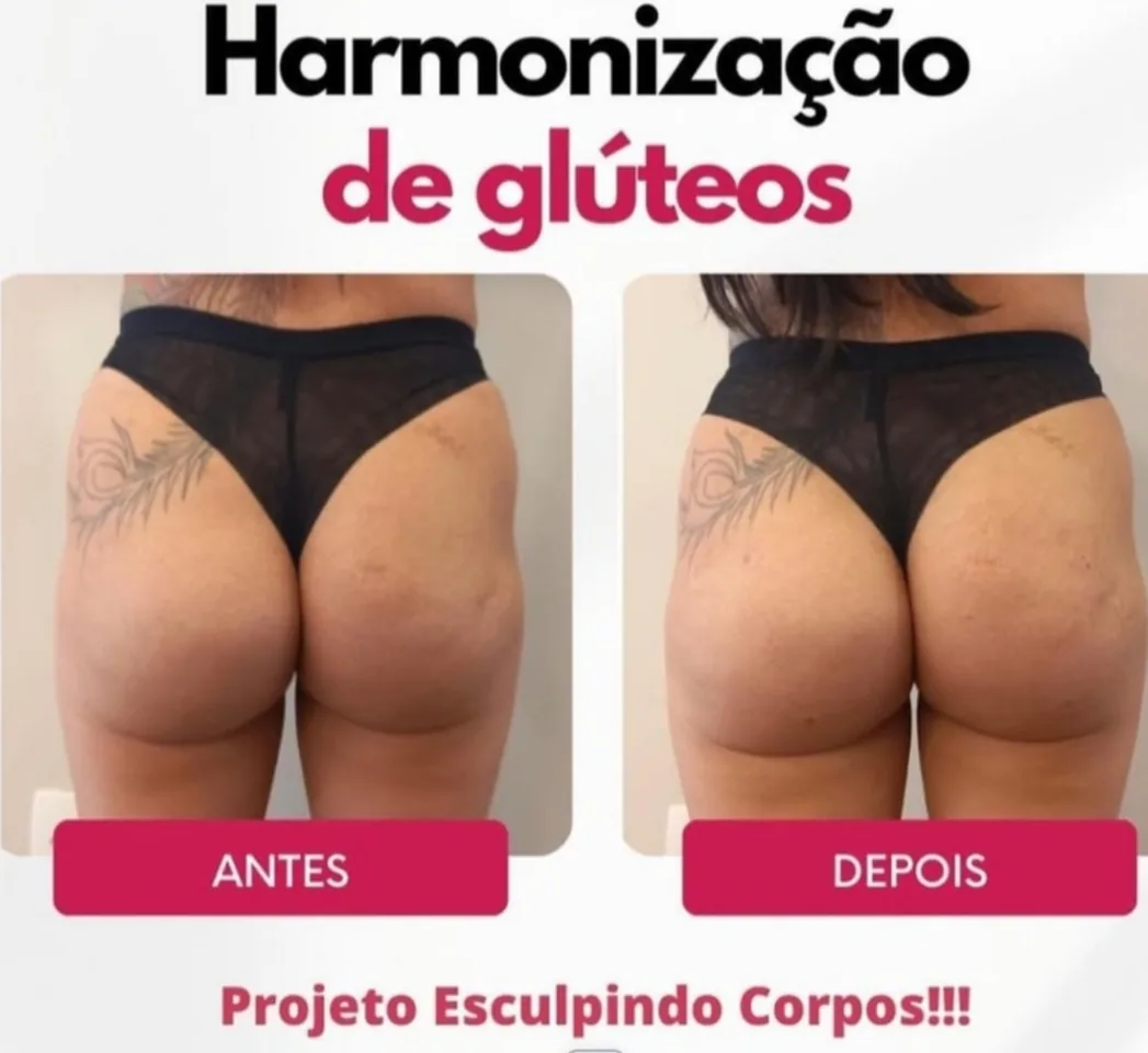 Antes e depois de harmonização de glúteos