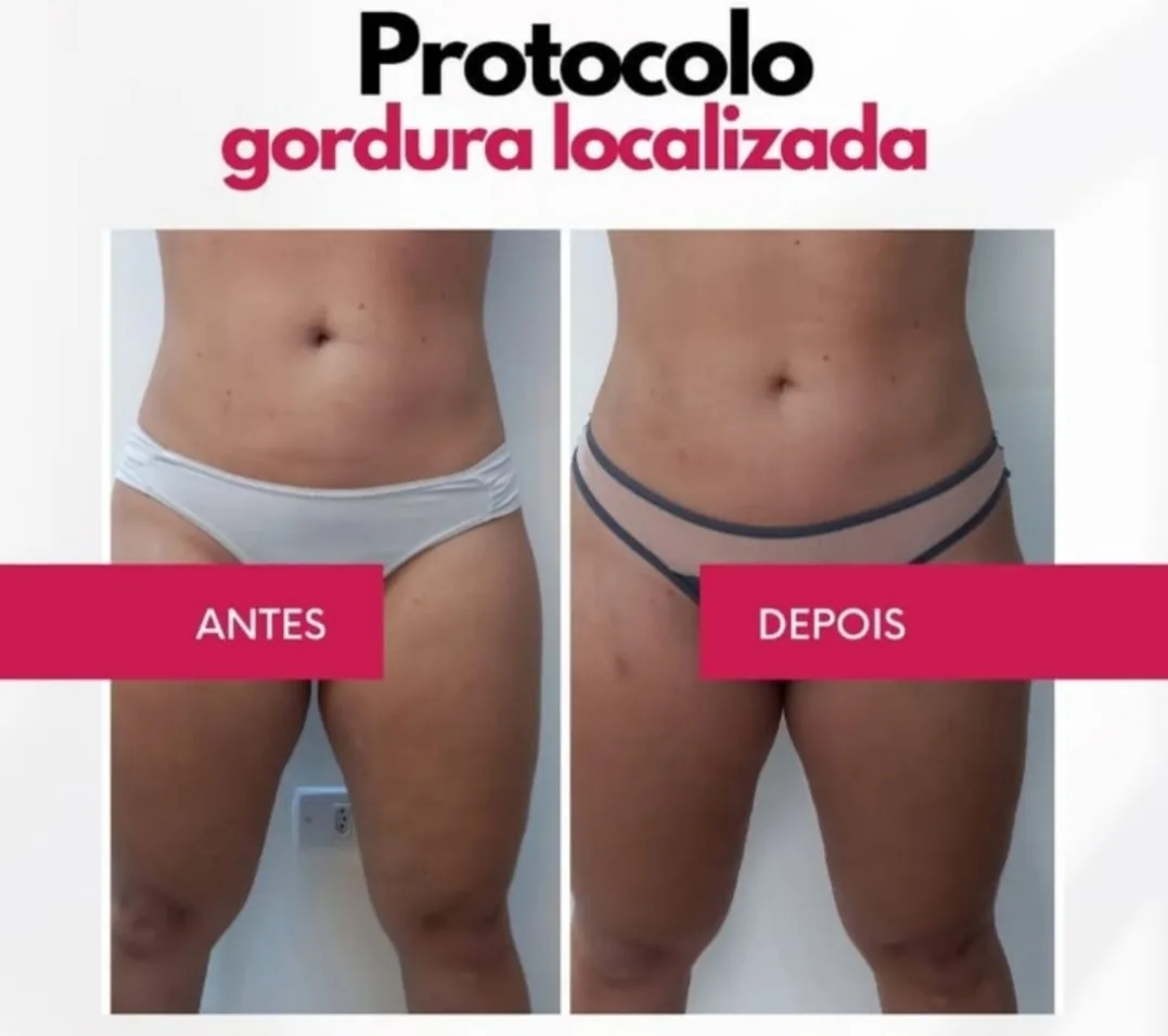 Antes e depois de protocolo para gordura localizada