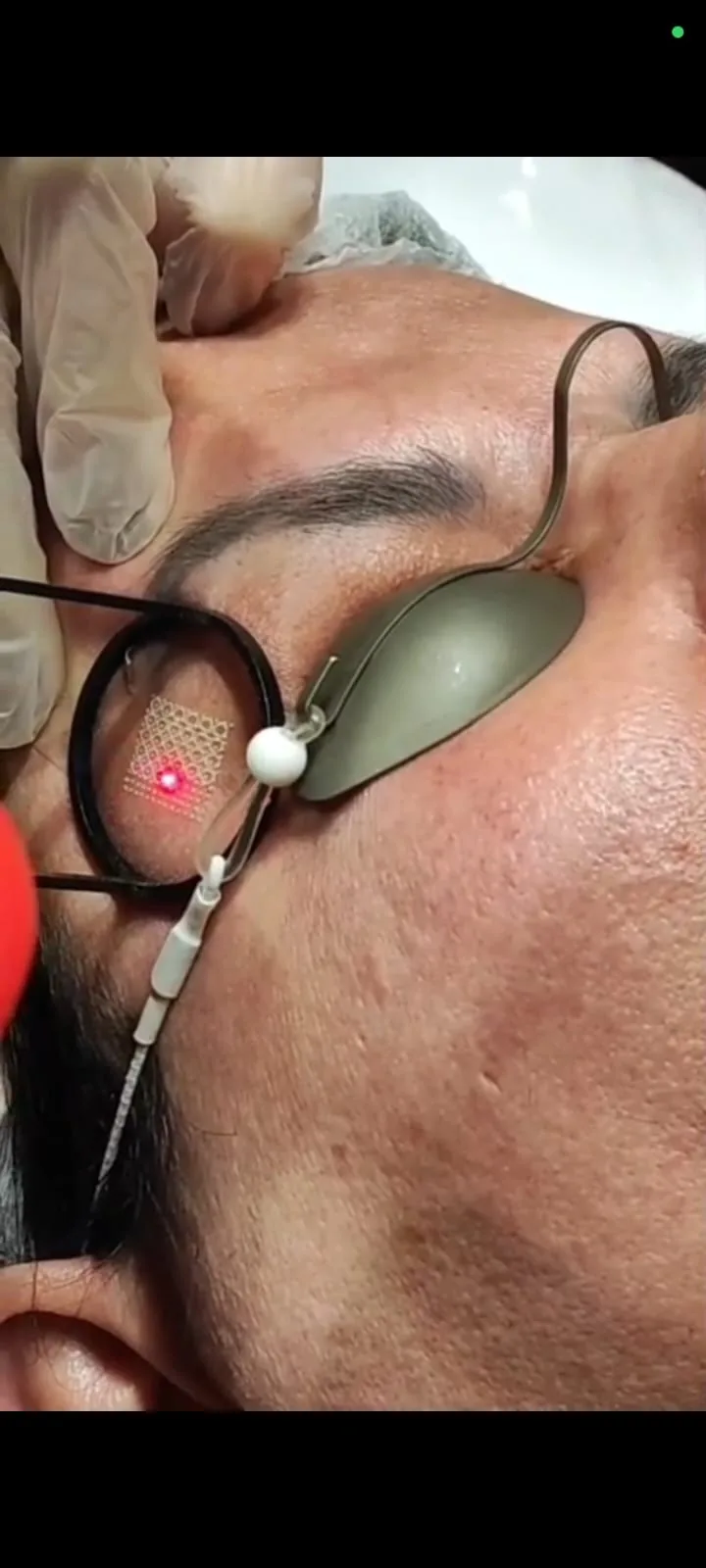 Aplicação de laser CO₂ fracionado