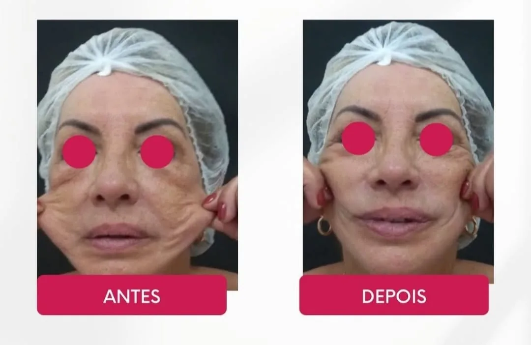 Antes e depois de tratamento para flacidez facial