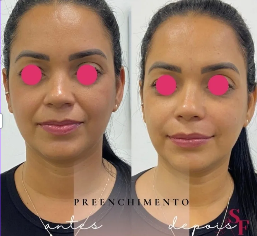Antes e depois de preenchimento facial