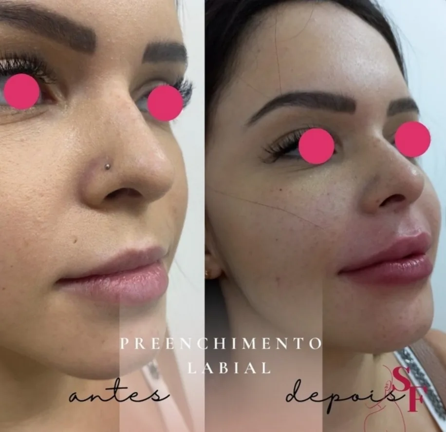 Preenchimento labial