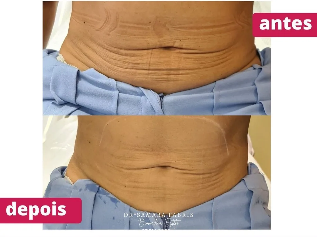 Antes e depois de tratamento de flacidez abdominal