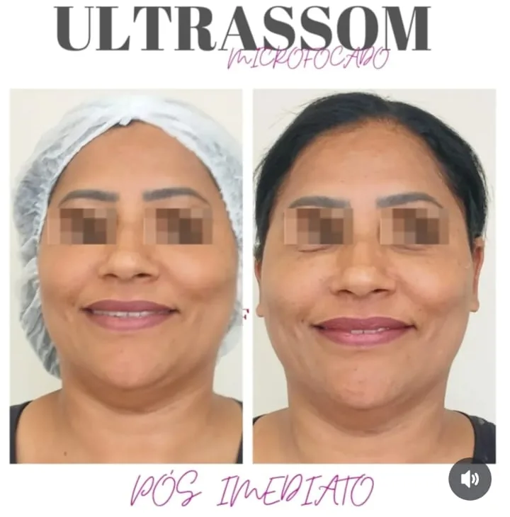 Ultrassom microfocado facial, pós imediato